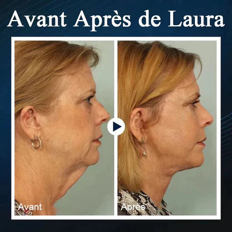 Appareil de beauté du visage en V endormi - Image 6