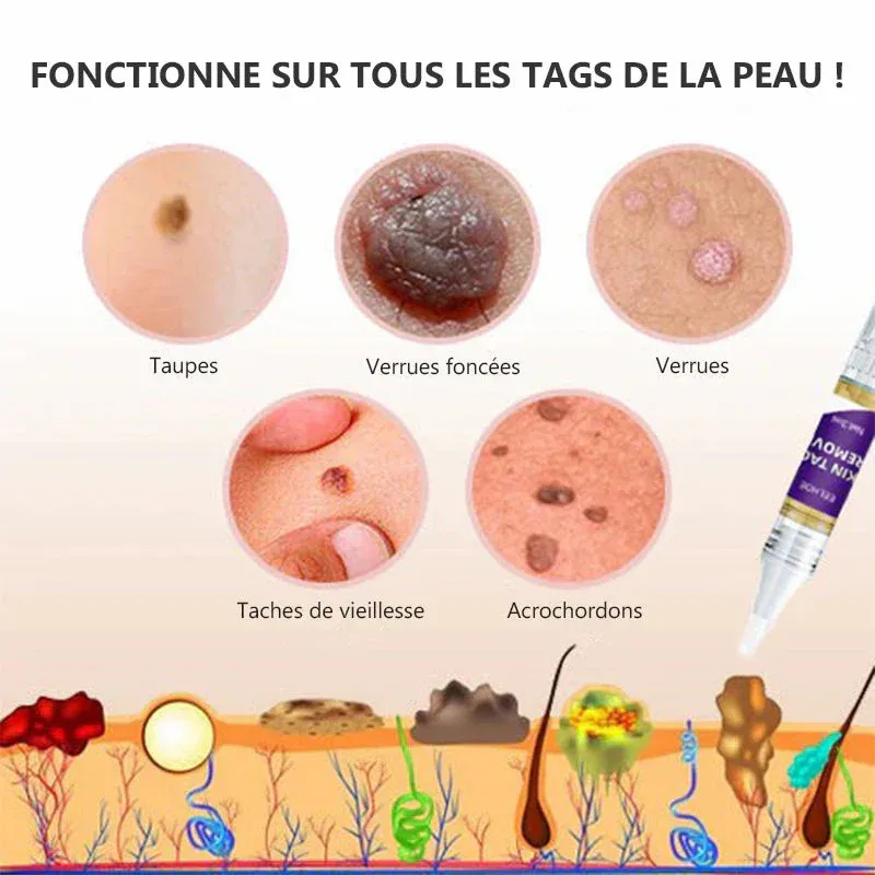 Stylo anti-acrochordons retirer des étiquettes de peau (2 pièces) - Image 7